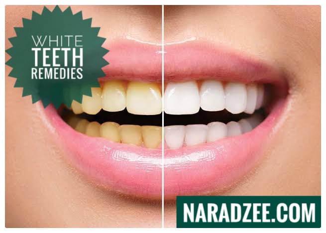 White Teeth Remedies